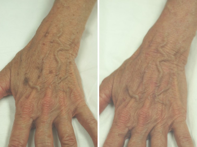 Laser Hand Rejuvenation
