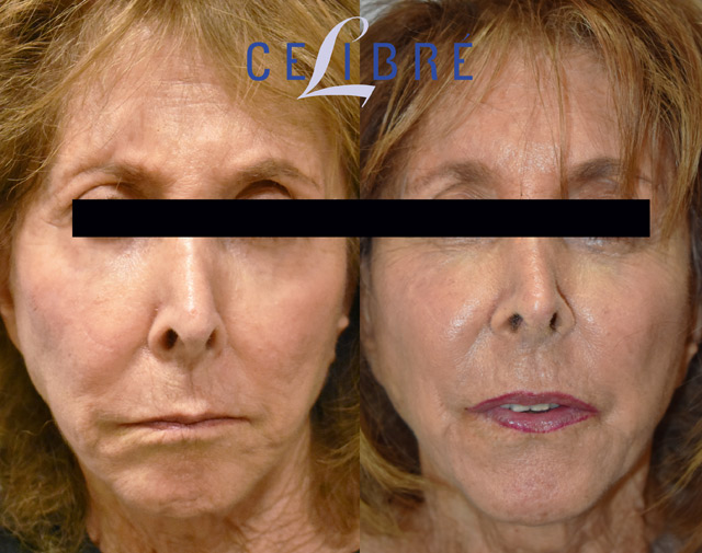 Sculptra Skin Tightening
