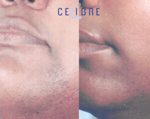 laser hair removal side effects