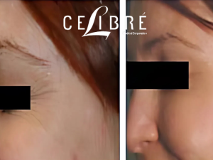 Wrinkle Removal Treatments