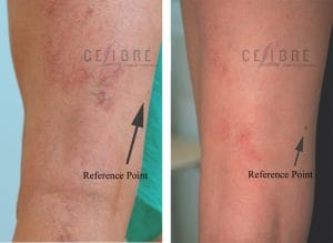 Laser for Spider Veins
