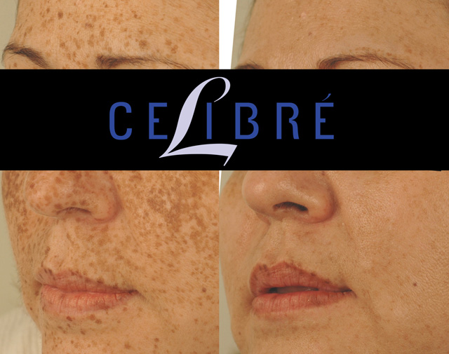 How to Remove Sun Spots on the Face