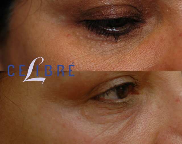 Syringoma-before-after