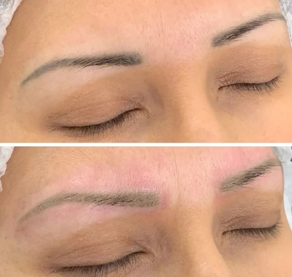 Tattoo and permanent makeup removal