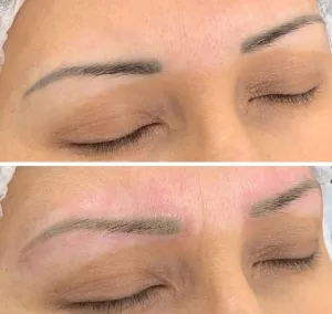 Tattoo and permanent makeup removal
