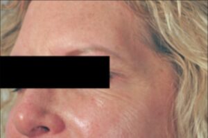 Temporal Hollowing