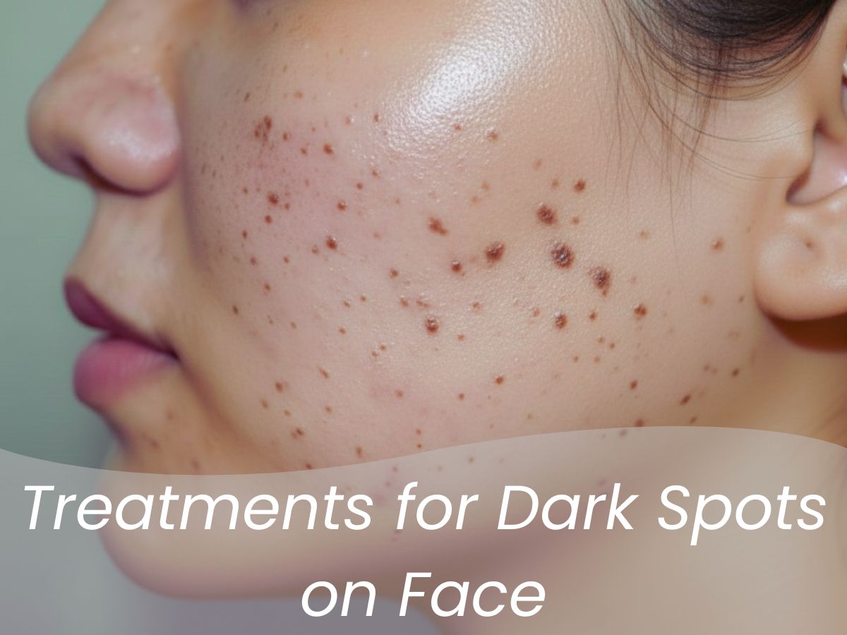 Treatments for Dark Spots on Face
