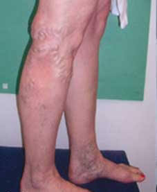 Spider Veins or Varicose Veins