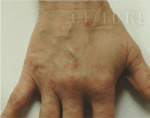 Removing Veins From Hands