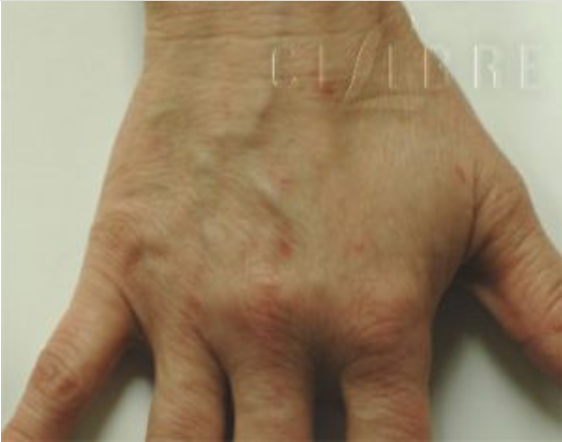 Veins on Hands