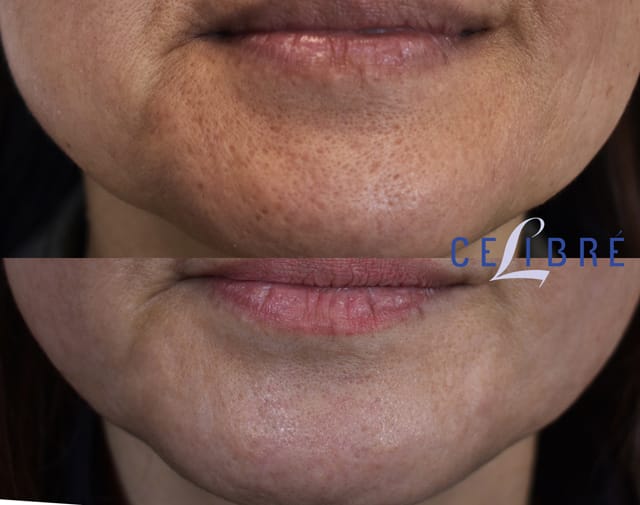 What Causes Acne Scars