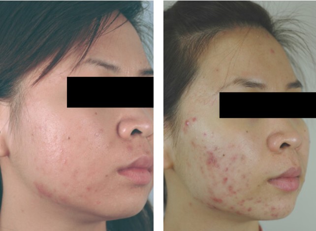 What Causes Fungal Acne