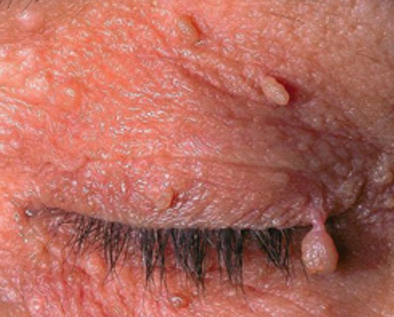 What Causes Skin Tags on the Face