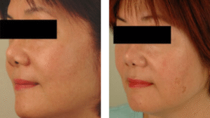 What Causes Sun Spots