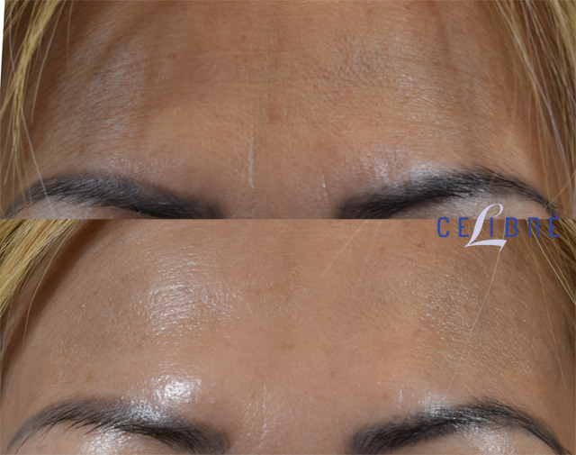 What Does a Botox Do