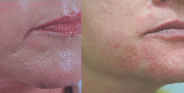 What Happens when dermal fillers wear off