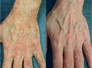 best laser for age spots