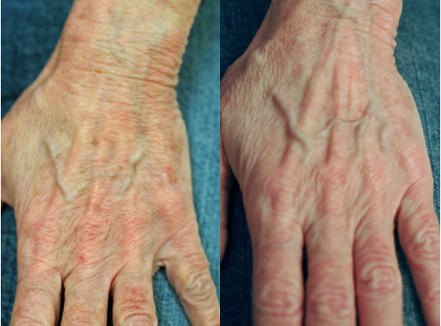 Which Lasers Remove Age Spots