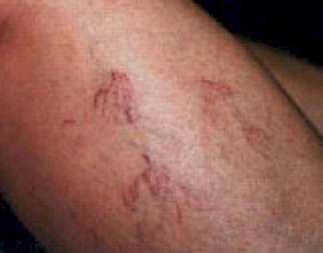 Why Do I Have Spider Veins
