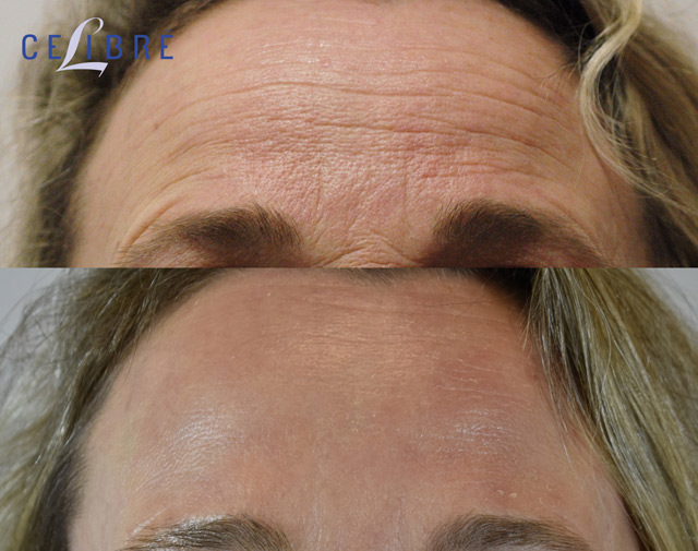 Wrinkle Removal