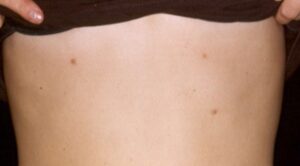 accessory nipple removal