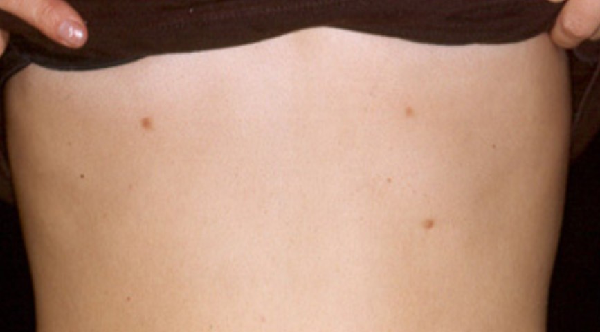 accessory nipple removal