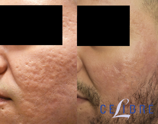 acne scar before and after