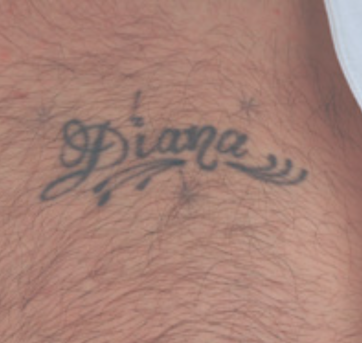 aftermath of tattoo removal