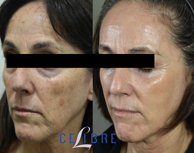 Before and after results showing visible skin improvement following one deep Erbium laser resurfacing treatment.