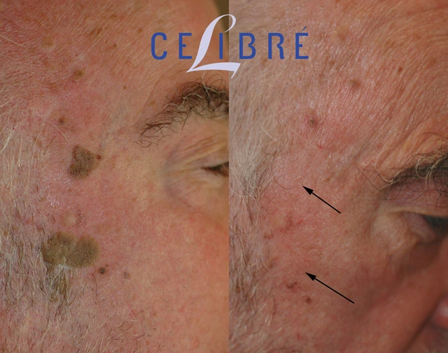 Before and after photos showing seborrheic keratosis removal, highlighting visible skin improvements and a smoother, clearer-looking complexion.