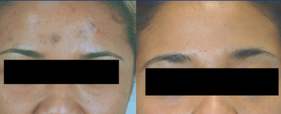 best treatment for pih