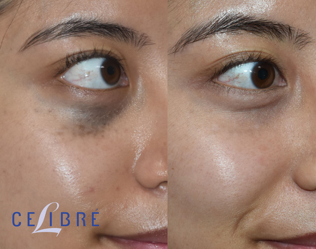Before and after comparison of birthmark around eye after laser treatment demonstrating smoother and even tone