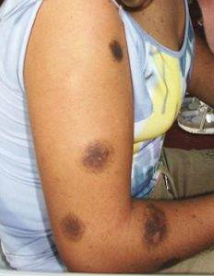 laser hair removal on birthmarks