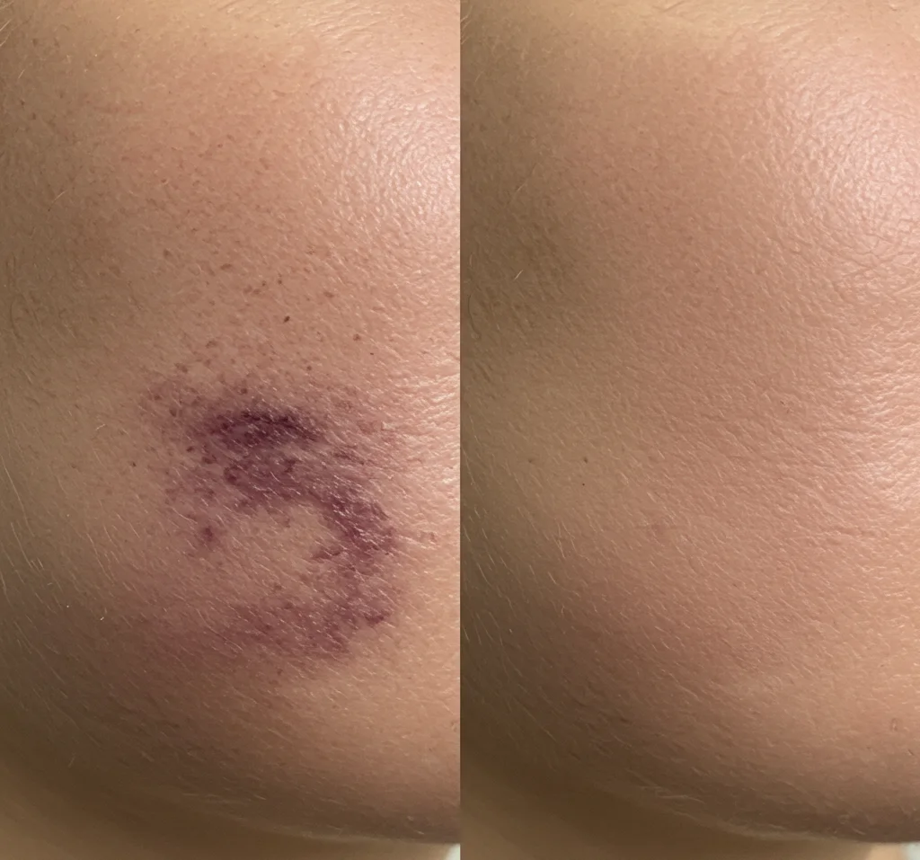 bruise before after