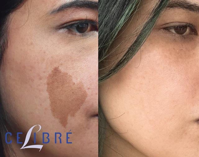 Cafe-au-lait-birthmark-removal treatment helps reduce pigmentation, restoring clearer, even-toned skin with advanced care