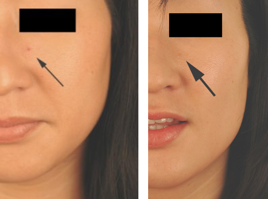 Remove Cherry Angioma