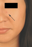 cherry-hemangioma-Before-laser-small