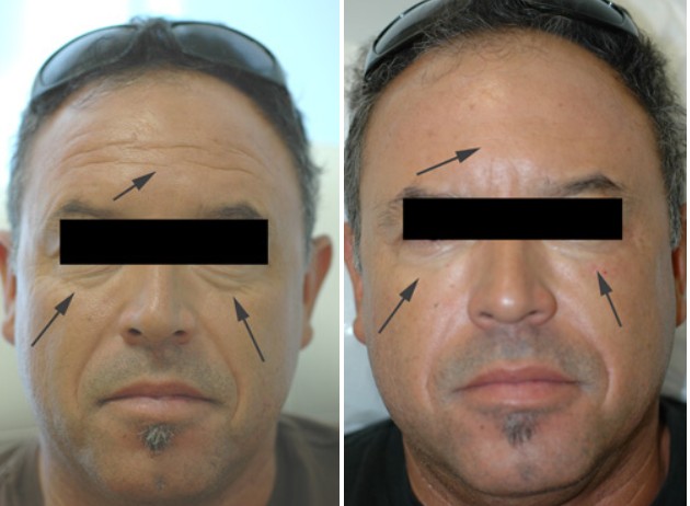 crepey skin under eyes