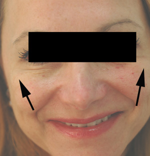 Difference Between Dysport and Botox