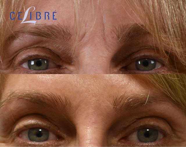 dysport before and after