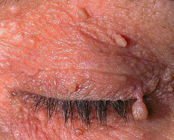 How to Prevent Skin Tags