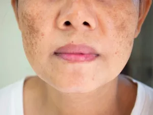 Melasma Facial