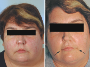 facial shaping