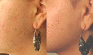 fake tan and laser hair removal