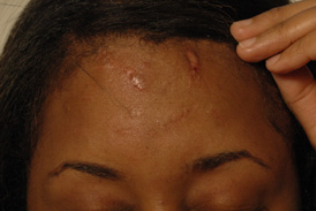 forehead scars