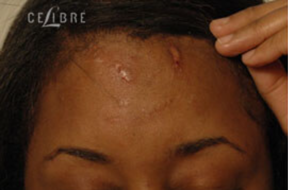 fraxel laser dark skin