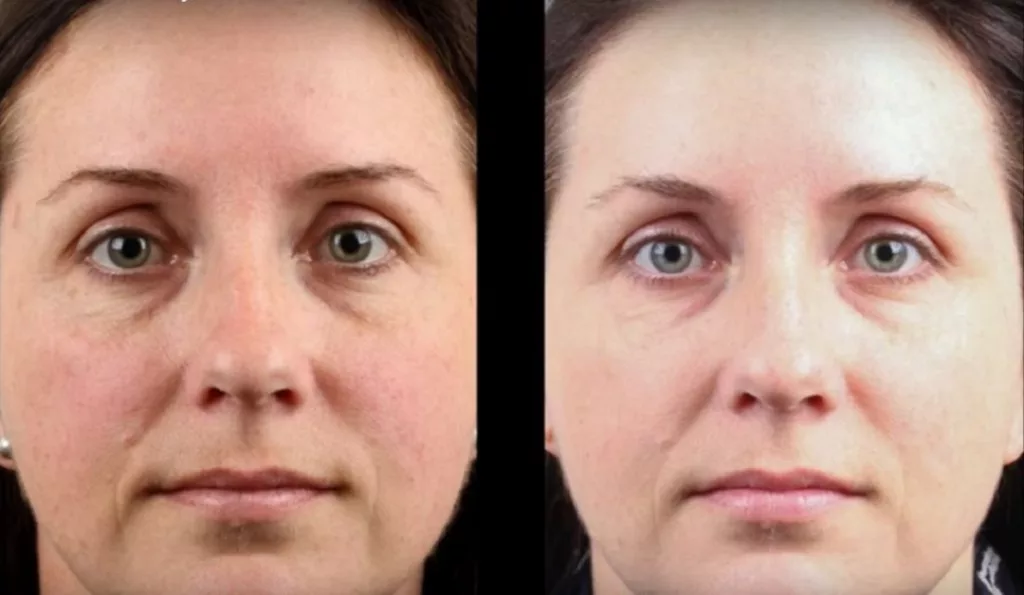 freckles laser treatment