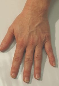 hand-rejuvenation-before-restylane