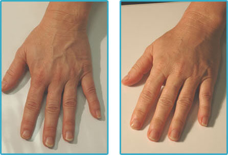 hand rejuvenation before and After