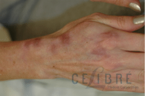 how to get rid of red acne scars